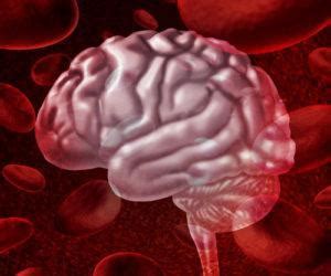 If a person has oral cancer how long can the person live after getting oral cancer? How Long Can You Live With a Brain Bleed? | Pintas ...