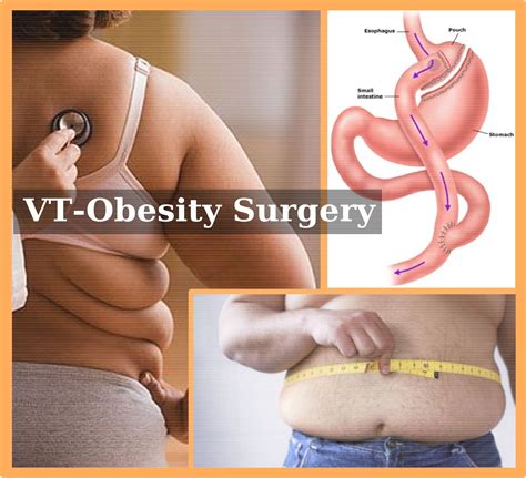 What is yamaha customer care number? (health complaints) VT-Obesity Surgery - World's Most ...