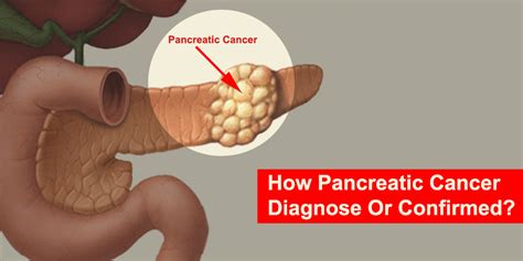 Diagnosing pancreatic cancer usually happens when someone comes to the doctor after experiencing weeks or months of symptoms. How Pancreatic Cancer Diagnose Or Confirmed ?LPC
