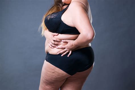 Typically, lipoma removal is covered by insurance. Dercum's disease - Total Lipedema Care