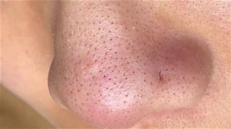 Normally, blackheads are common, and may just appear without obvious explanation, but there are some things contributing to the formation of blackhead 2. Remove small Blackheads on nose #03 - YouTube