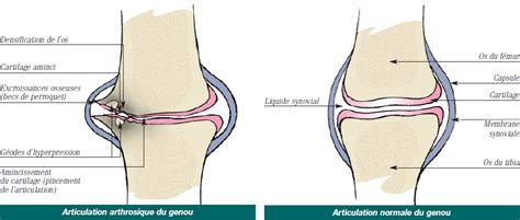 Les douleurs projetées sont, en fait, des erreurs cérébrales comme la douleur du bras gauche lors d'un infarctus du myocarde. Arthrose du Genou : Arthrose Genoux | Douleur de Genou