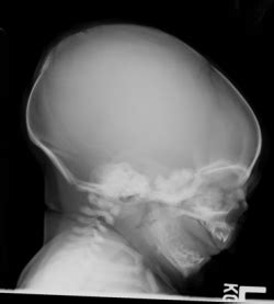 Ap skull landmarks6p image quiz. Pediatric Skull - Elements of Radiography