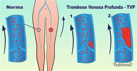 Een vraag stellen over trombose? Se tens algum desses sintomas podes ter trombose venosa ...