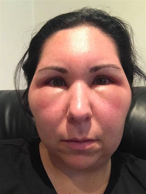 Mariade kelly's skin weeps and burns following an allergic reaction to hair dye a mum was left terrified and fighting for her life after suffering an allergic reaction to a bottle of hair. Woman's Face Balloons After Severe Allergic Reaction To ...