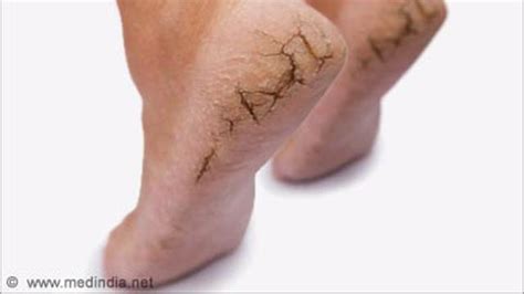 Kekurangan vitamin d akan menyebabkan kelainan bentuk yang serius pada tulang. Kulit Kaki Kering & Pecah Tanda Kurang Vitamin B - Health ...