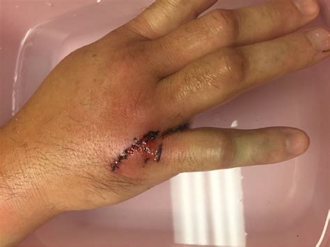 Fight Bite Sustained With Metacarpal Neck Fracture ...