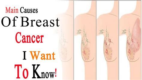 Signs of a more serious condition (such as breast cancer) include discharge that: How Do You Know If You Have Brest Cancer - CancerWalls