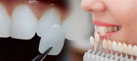 Veneer gigi adalah prosedur pemasangan lapisan buatan di atas permukaan gigi untuk mengubah warna, bentuk, panjang atau lebar gigi, serta posisinya agar gigi kembali terlihat sehat dan utuh. Prosedur, Harga Veneer Gigi, dan Alasan Menggunakannya ...