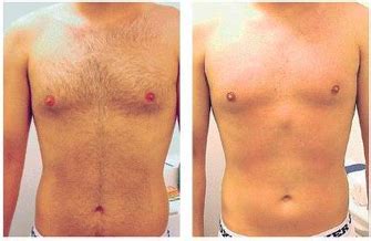 Who can do brazilian laser hair removal? Hair Removal for Men in Richmond, VA: Service list & prices