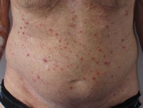 Aitl is generally a rapidly progressive disease. Angioimmunoblastic T-cell lymphoma | DermNet NZ