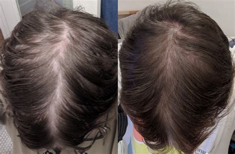 These toppers can also be used as volumizers or integration hairpieces for. Crown Progress (~7.5 months vs. 10.25 months fin) : tressless