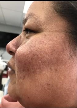 I will also be giving you my jan marini skin care management system review since i have been using. Chemical Peels Patient #1431 | Before & After Gallery