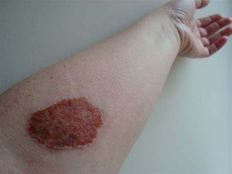 Maybe you would like to learn more about one of these? Allergic to Hair Dye Skin Test, Black Henna Tattoo, Dyed ...