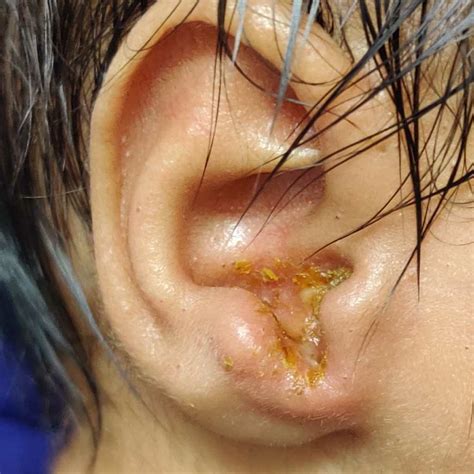 In the united states, there are over 25 million visits to pediatricians each year related to ear infections, making it the most common diagnosis for children. can i use cotton swabs to Clean my babys nose and ear ...
