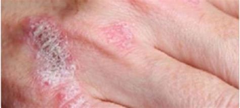 Pode progredir para psoriase em placas. A MILAGROSA PLANTA QUE TRATA PSORÍASE, ECZEMA, DERMATITE E ...