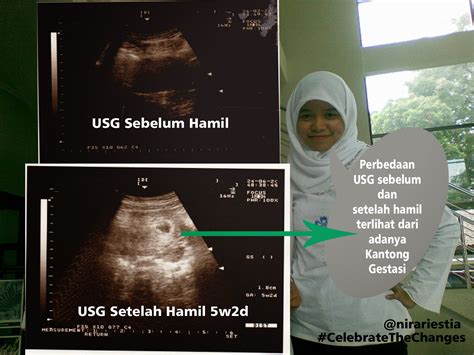 Foto hasil usg janin itupun viral setelah dibagikan akun twitter @madoka_people. Perbandingan hasil USG sebelum dan setelah hamil | SHKUTER (SHare.KUmpul.TERuskan)