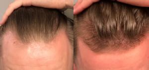 Minoxidil can increase the density and thickness of hair. benefits of minoxidil for hair on finasteride and minoxidil for 4 months (photo ...