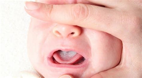 Istilah untuk menyebur kondisi mulut yang mengalami bercak berwarna keputihan, disebut oral thrust. Bersihkan Selaput Putih Di Lidah Bayi Bagi Elak Jangkitan ...