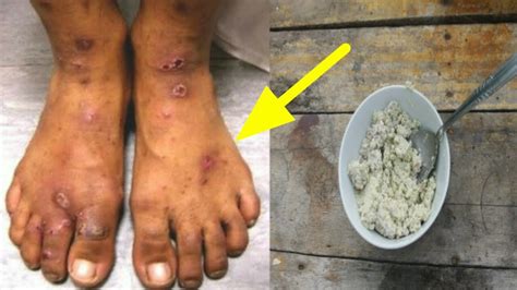 Menjaga kebersihan kulit kaki sama pentingnya dengan merawat kulit wajah. Cara Hilangkan Parut Hitam Di Kaki
