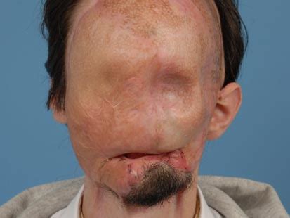 13, 2010 file photo, dallas wiens, 25, speaks during an interview in fort worth, texas. Full Face Transplant for Dallas Wiens, Texas Construction ...