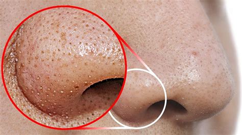 Removing blackheads is a pain, but don't worry, we've got you covered. Easy Ways To Totally Clear Blackheads From Your Face - The ...