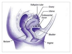 The most common symptom is pelvic pain. Endometrioza - Keshilla.NET