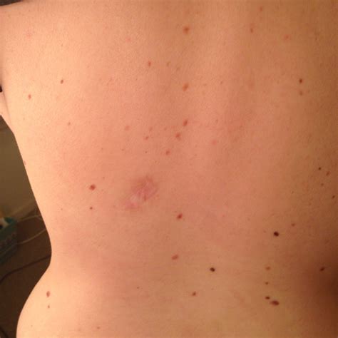 The main types of skin cancer are: I Didn't Think I Would Get Skin Cancer Either - Blushing ...