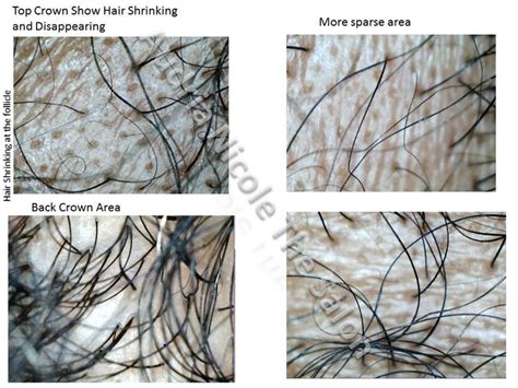 It makes sense to worry that keeping your hair cooped up under a wig for weeks or months might stop it from growing, but rest assured: We offer microscopic digital analysis of the scalp to help ...