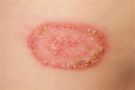 Kurap (kadas) adalah penyakit kulit akibat infeksi jamur yang menyerang permukaan kulit. Obat Herbal Yang Bagus Untuk Menyembuhkan Penyakit Kulit ...