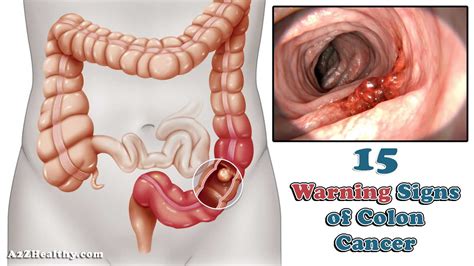 But some common signs and symptoms show that a person is entering the final weeks and days of life. 15 Warning Signs of Colon Cancer You Should Not Ignore