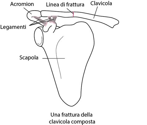 Fratture della clavicola - Lesioni e avvelenamento ...