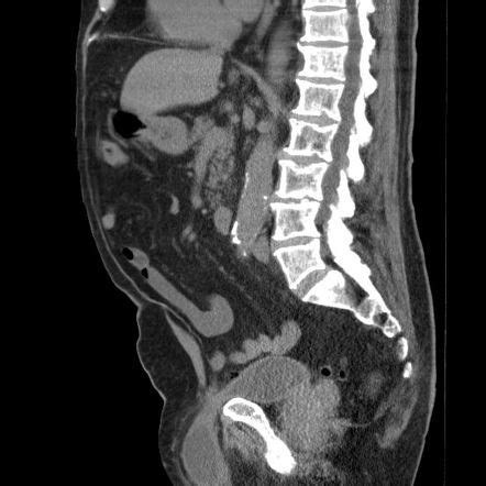 Maybe you would like to learn more about one of these? Scrotal cystocele | Radiology Reference Article ...