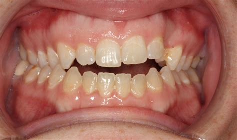 This is why it's important to know how to fix a crossbite in adults, even if your bad bite doesn't bother you now. Pin by Dr. Cathleen George Orthodonti on Accelerated ...