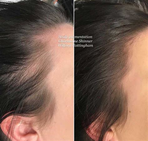 Maybe you would like to learn more about one of these? Scalp Micropigmentation Before and After Pictures - PMUHub