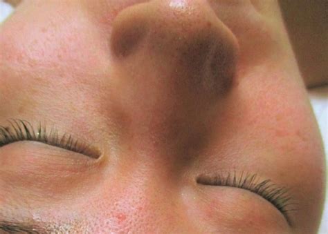 お肌の〝夏バテ"は、ダイヤモンドピーリングが効果的 ...