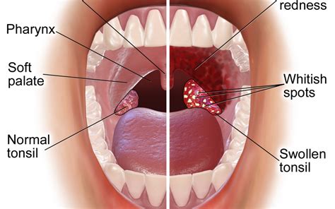 Signs and symptoms of tonsillitis include swollen tonsils, sore throat, difficulty swallowing and tender lymph nodes on the sides of the neck. Tonsillitis | ENT Buffalo NY | Dr. Paul R. Young, MD