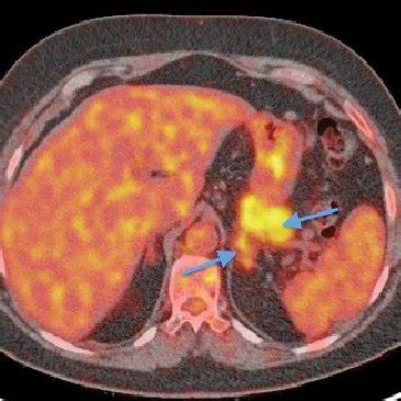 Many cancers have elevated glucose uptake and hexokinase levels. (PDF) Study of systemic disease IgG4. Usefulness of 2-[18F ...