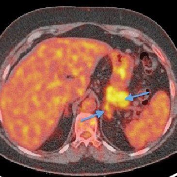 See actual entry in rtecs for complete information. (PDF) Study of systemic disease IgG4. Usefulness of 2-[18F ...