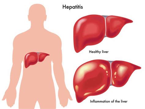 Hepatitis b hepatitis b yang akut tidak memerlukan pengobatan yang spesifik. Macam-Macam Penyakit Hepatitis Atau Radang Hati ...