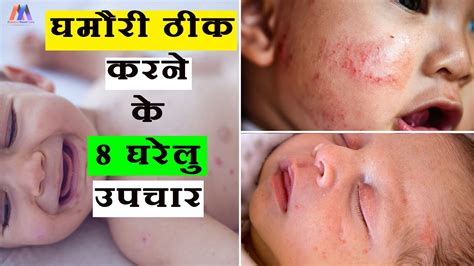 When your baby's body becomes hot, their skin begins to fortunately, heat rash isn't a serious condition. गर्मी में घमौरी ठीक करने के - 8 घरेलु उपचार || 8 Effective Home Remedies for Heat Rash in Babies ...