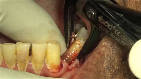 The second option, to extract the infected tooth, also has its issues. Failed root canal treated premolar extraction - YouTube