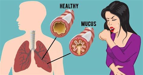 Avoid waiting rooms and traffic by using telehealth from home. How To Get Rid of Mucus And Phlegm in Your Chest And ...