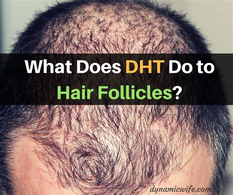 Among other foods and beverages, elements found in green tea, onions, pumpkin seeds, and edamame may help lower dht levels and prevent hair loss. What Does DHT Do to Cause Hair Loss in Men? | Hair loss ...