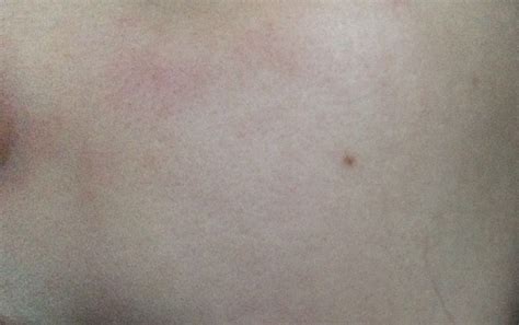 Aus diesem grund solltest du dich nicht. Pickel unter der Haut oder was anderes? (Rötung)