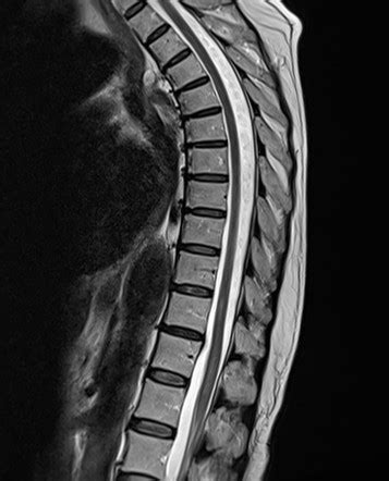 Acute partial transverse myelitis (aptm) is acute or subacute spinal cord inflammation involving only a portion of the spinal cord, but multiple definitions may be used, including the following. Transverse myelitis | Radiology Reference Article ...