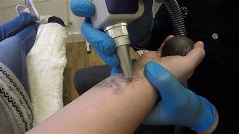 So the big question is: Laser Tattoo Removal - Bianco Beauty