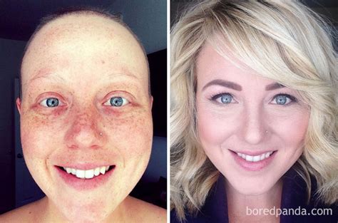 Cancer is a generic term for a large group of diseases that can affect any part of the body. 10 fotos de antes e depois de pessoas que venceram o câncer
