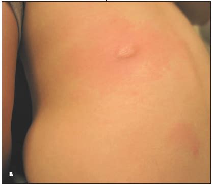 In general, the skin becomes swollen, itchy and red. Solitary Nodule With a Positive Darier Sign | Consultant360