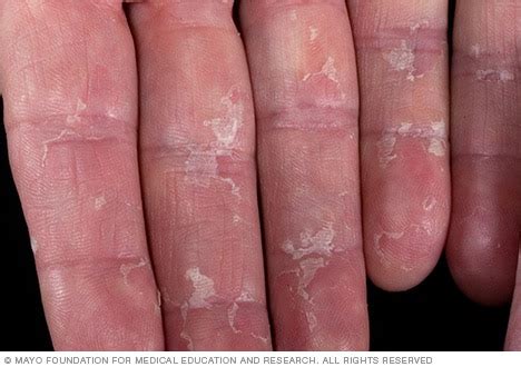 Treatments for causes of peeling skin on hands and feet. Peeling skin - Mayo Clinic
